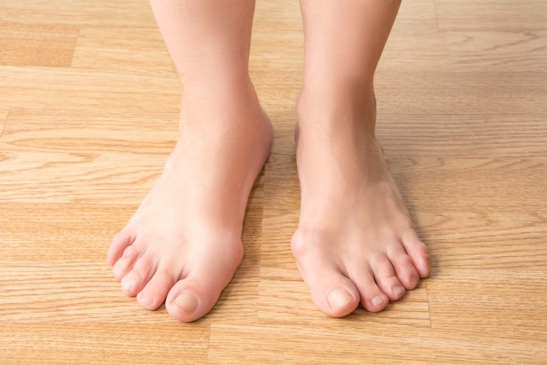 Bunions Foot Condition