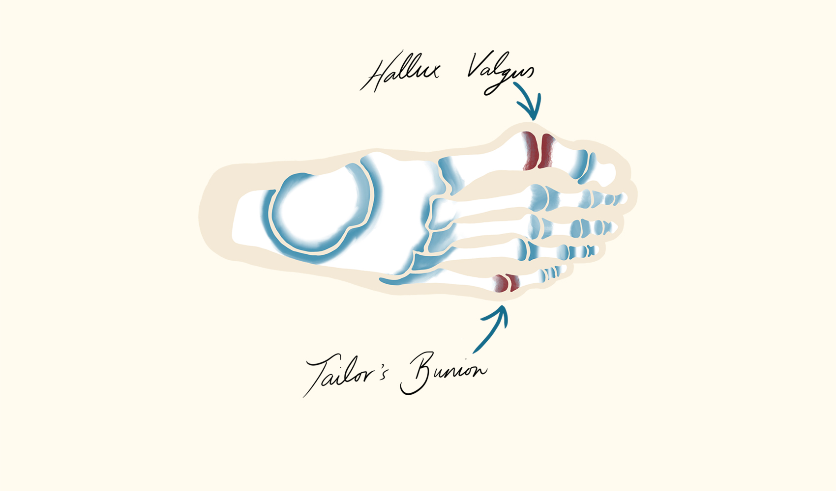 Bunions Hallux Valgus and Tailors Bunion Illustration