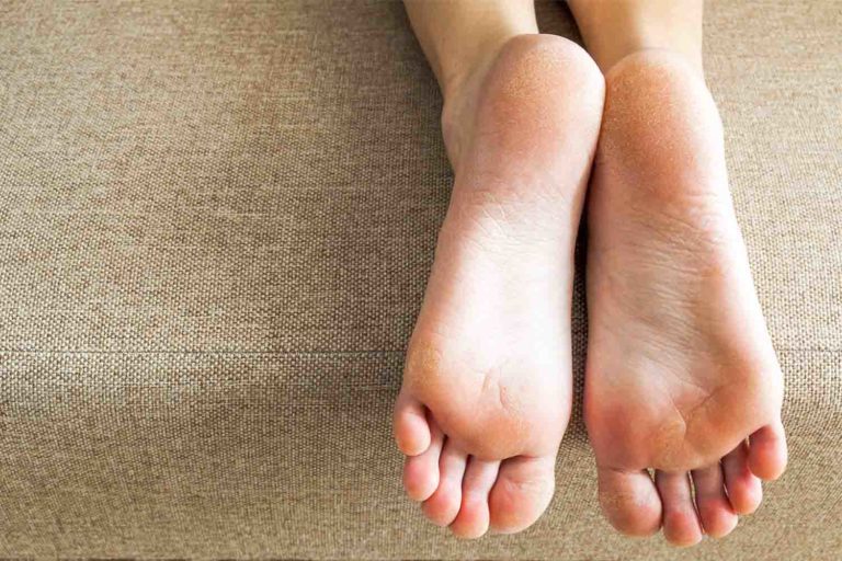 Calluses