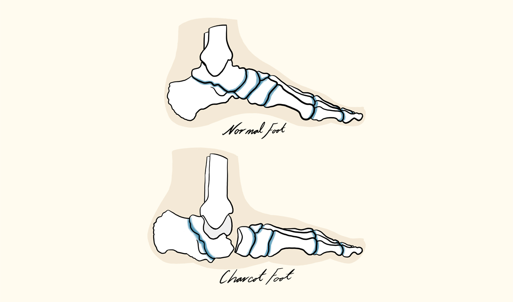 Charcot Foot Condition Diabetes