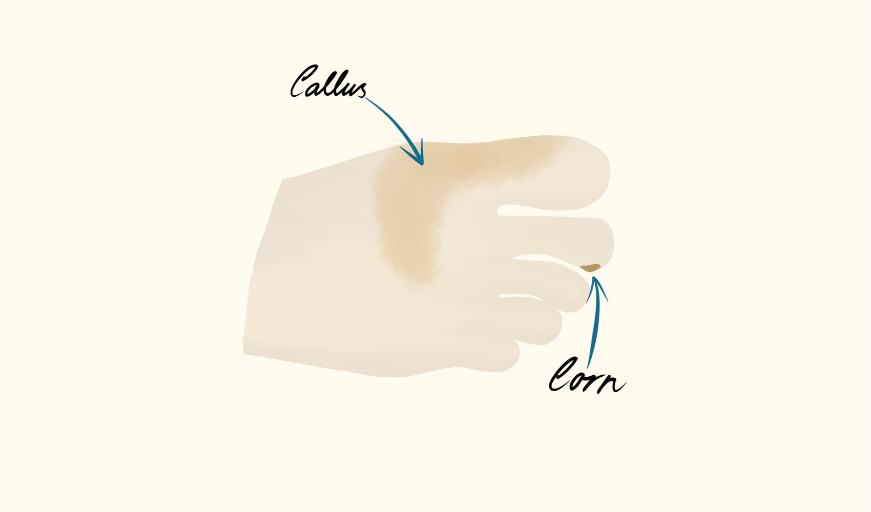 Corns and Calluses