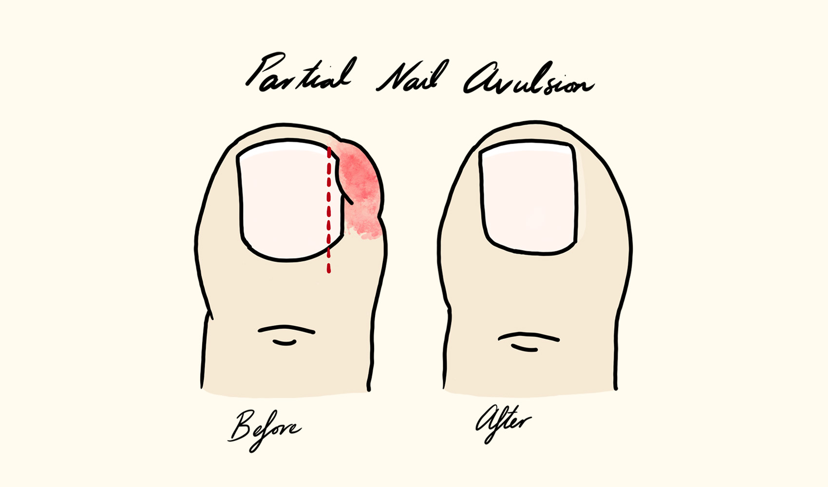 Ingrown Toenail Partial Nail Avulsion Illustration