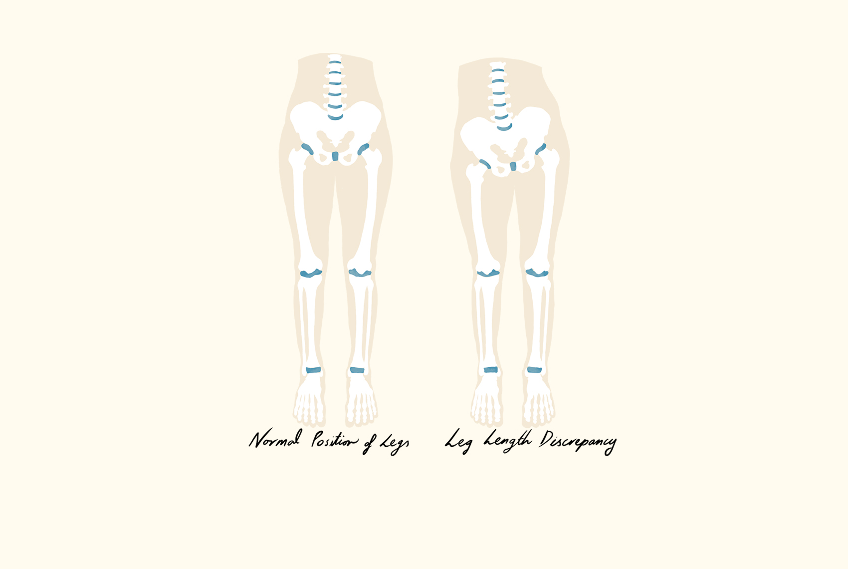 Leg Length Discrepancy Illustration Mobile