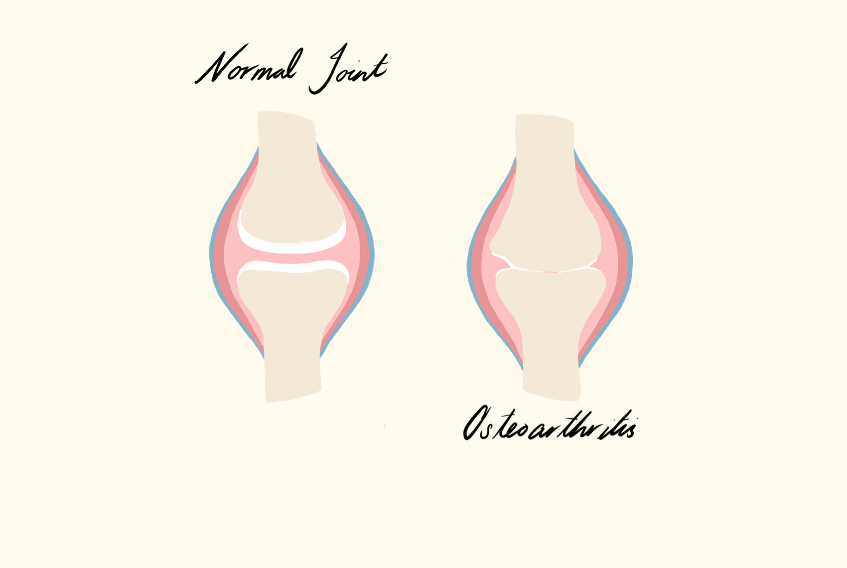 Osteoarthritis Condition Illustration