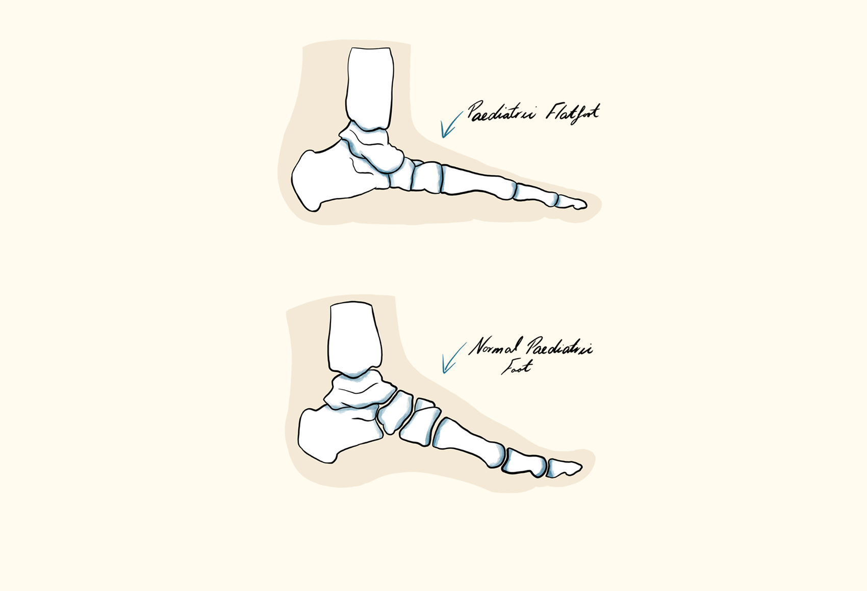Paediatric Flatfoot Illustration