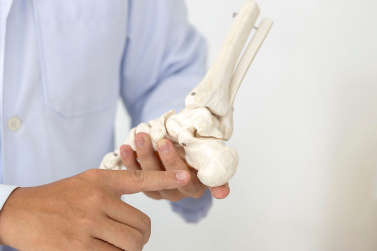Plantar Fasciitis