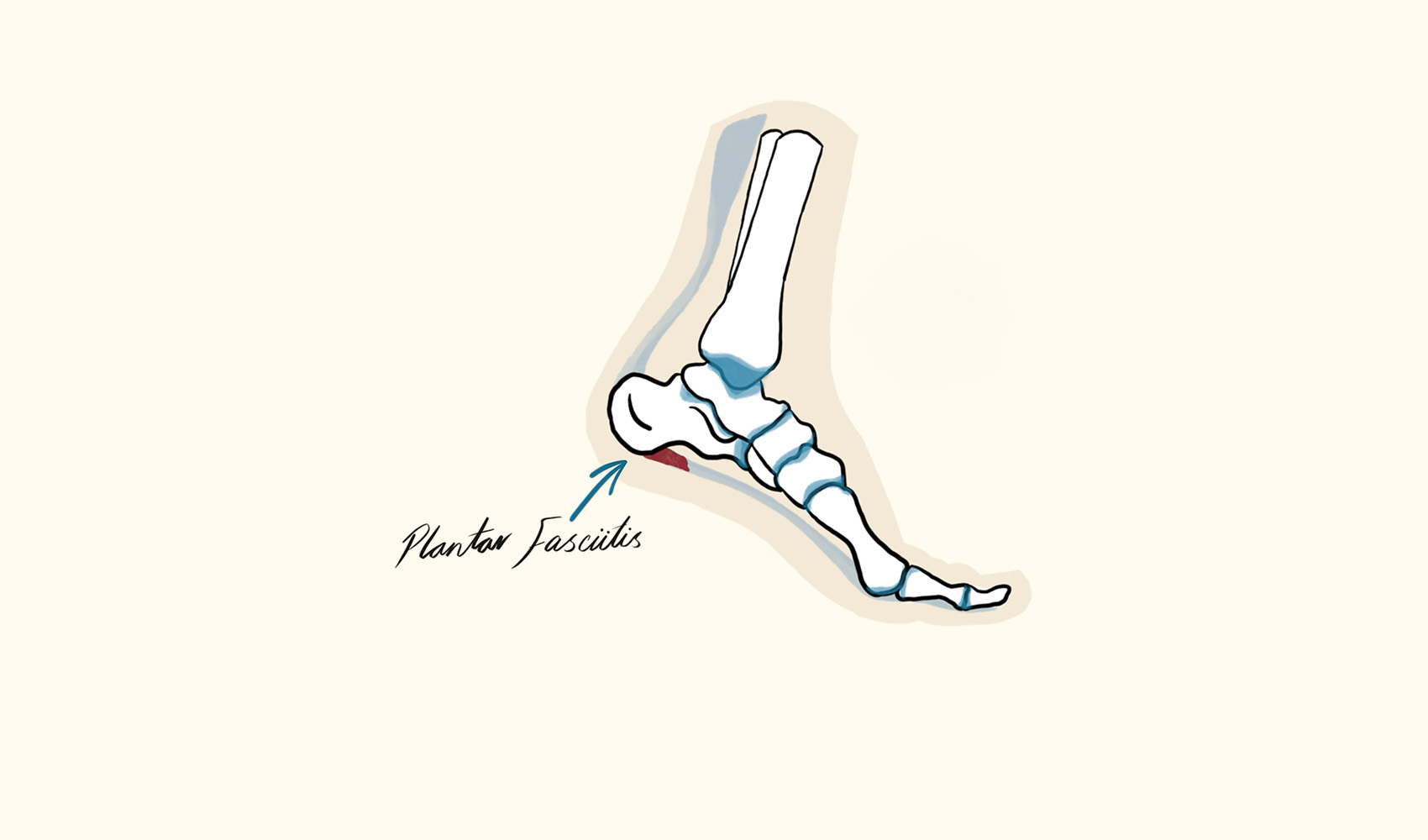 Plantar Fasciitis Illustration