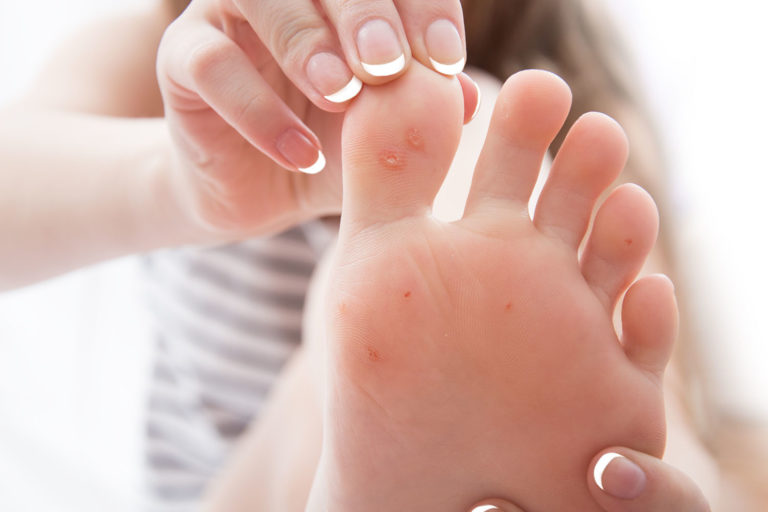 Plantar Warts