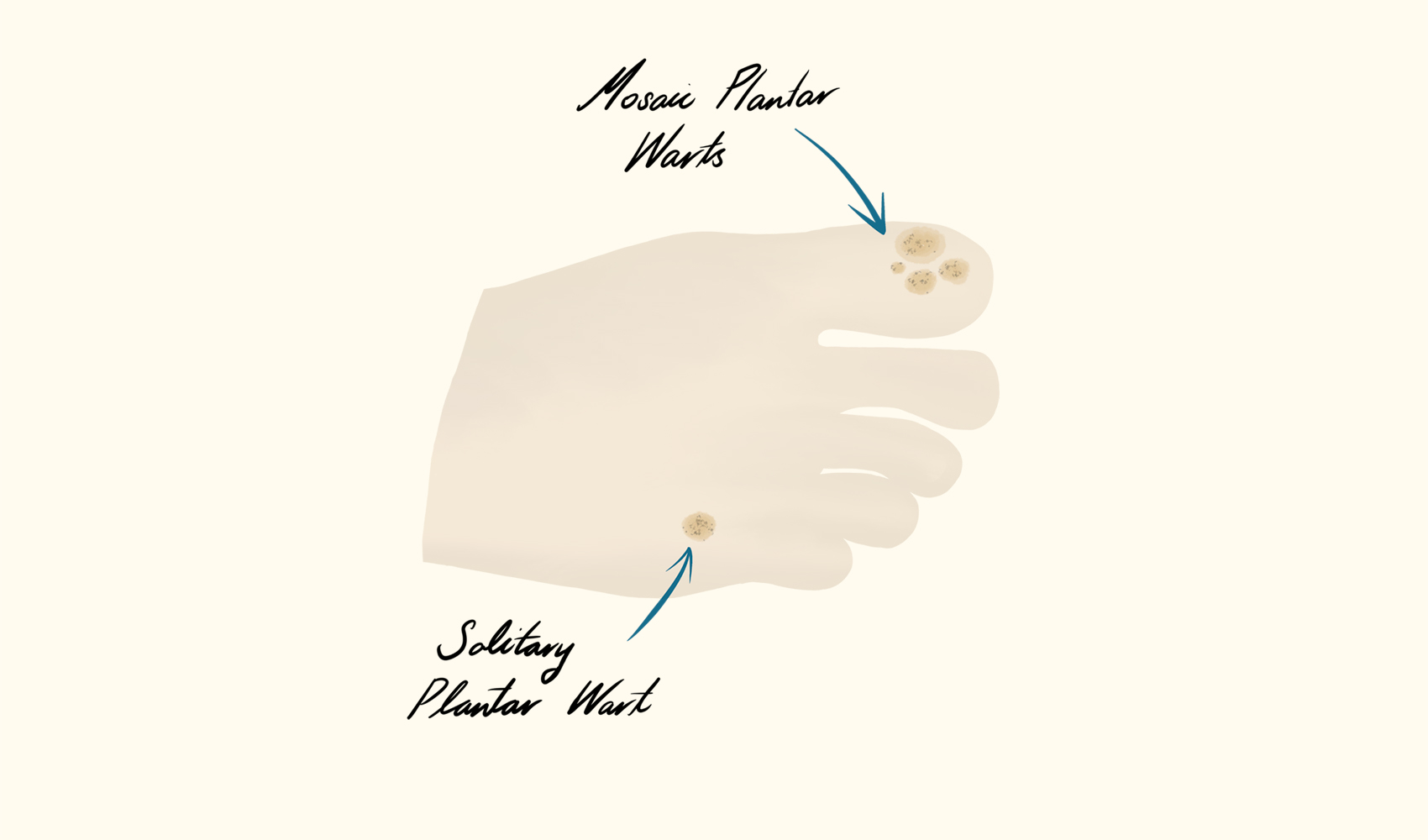 Types of Plantar Warts