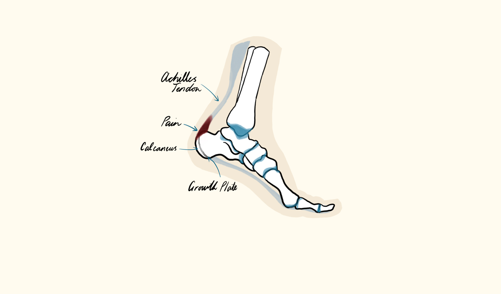 Severs Disease Illustration Mobile
