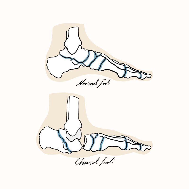 Diabetes Illustration