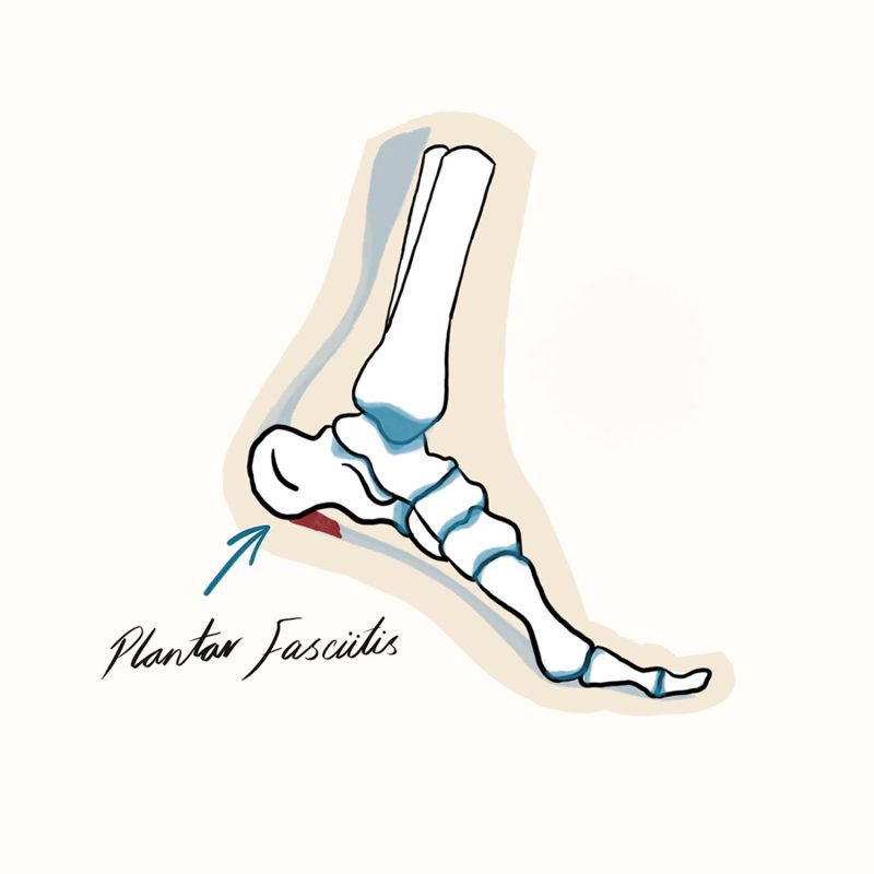 Plantar Fasciitis Illustration